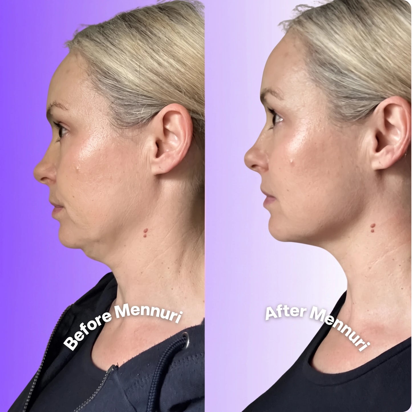 Mennuri - Invisible Neck Lifting Tape