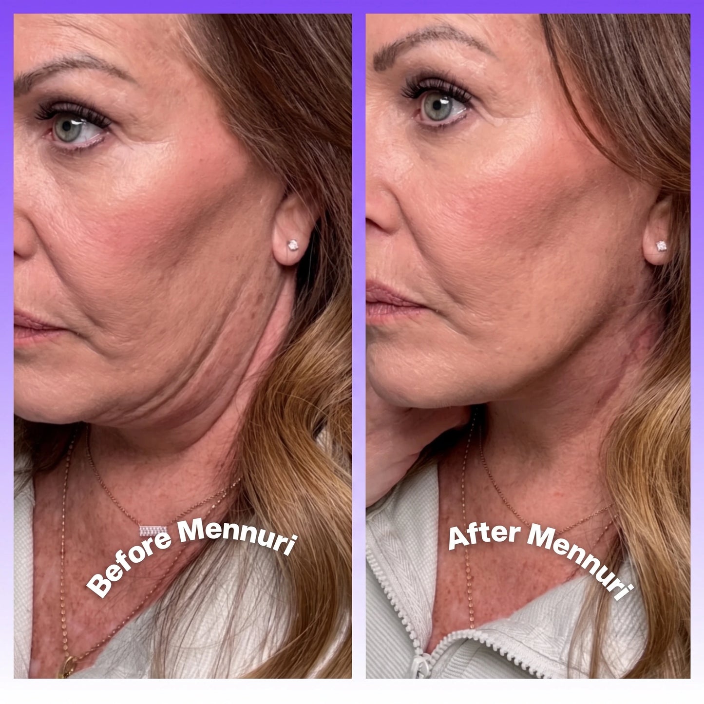 Mennuri - Invisible Neck Lifting Tape